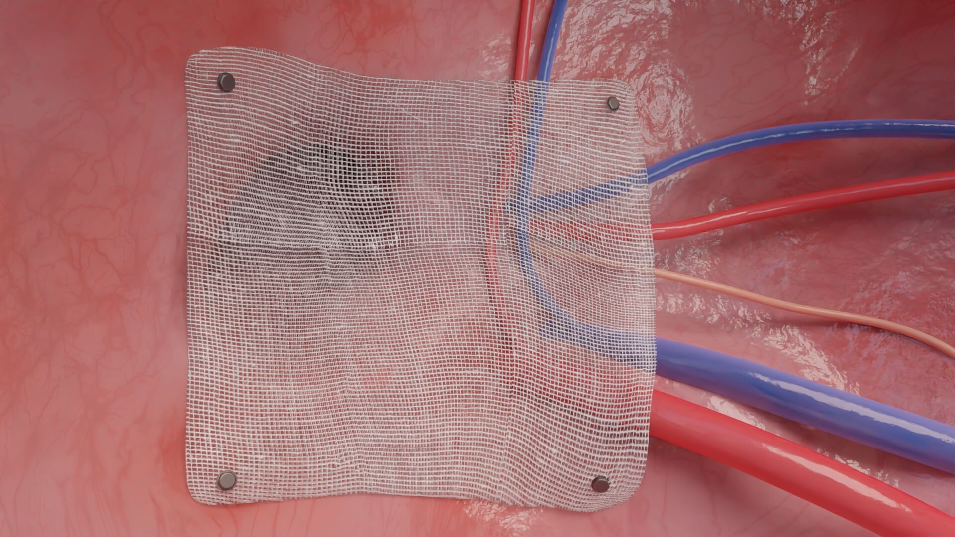 This is an image of a mesh used in hernia repair.